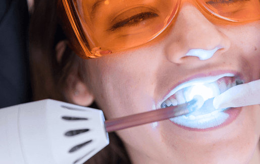 تبييض الأسنان بالزوم